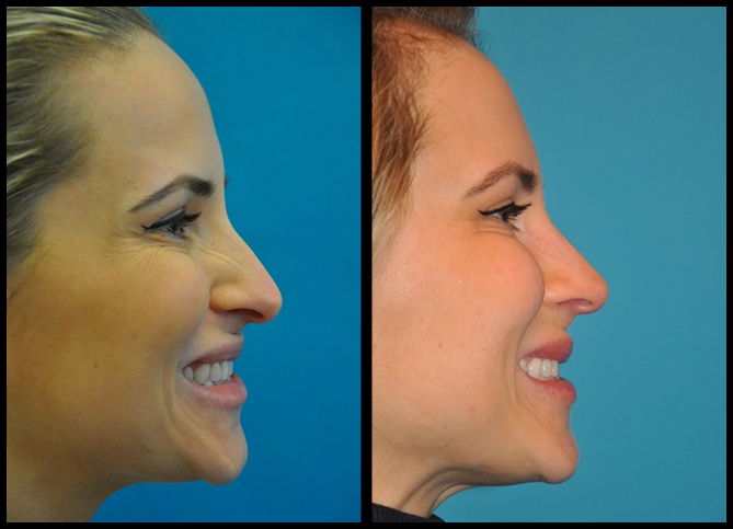 Before and After
