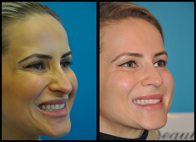 Before and After