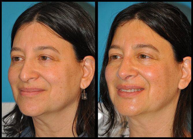 Before and After