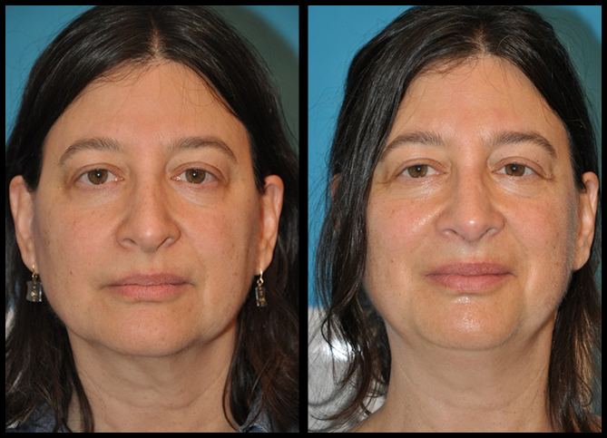 Before and After