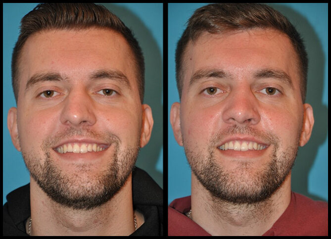Before and After