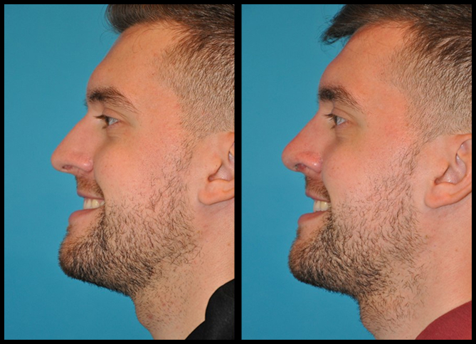 Before and After