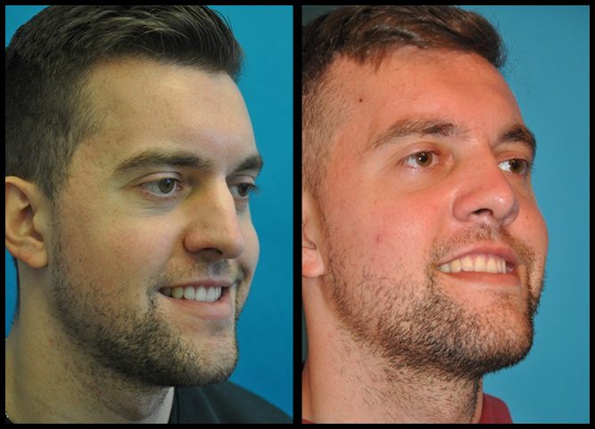 Before and After