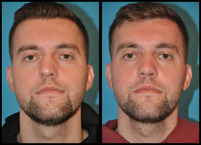 Before and After