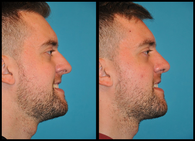 Before and After
