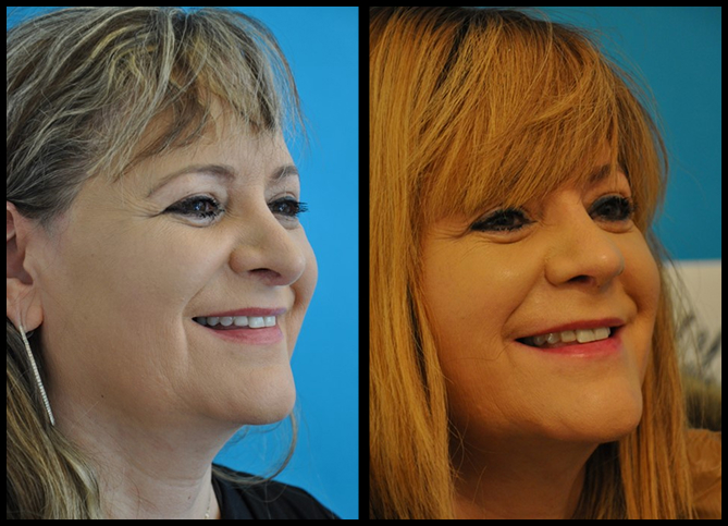 Before and After