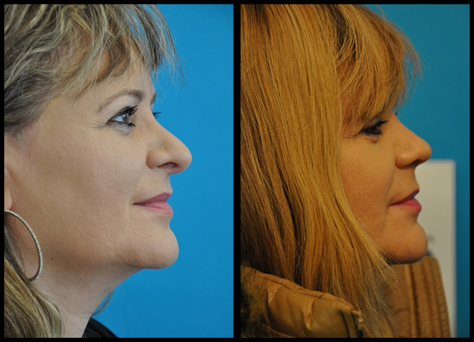 Before and After