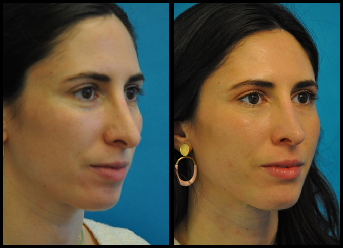 Before and After