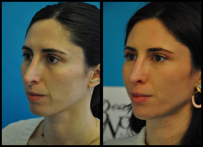 Before and After