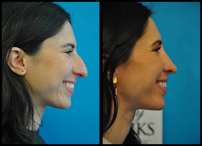 Before and After