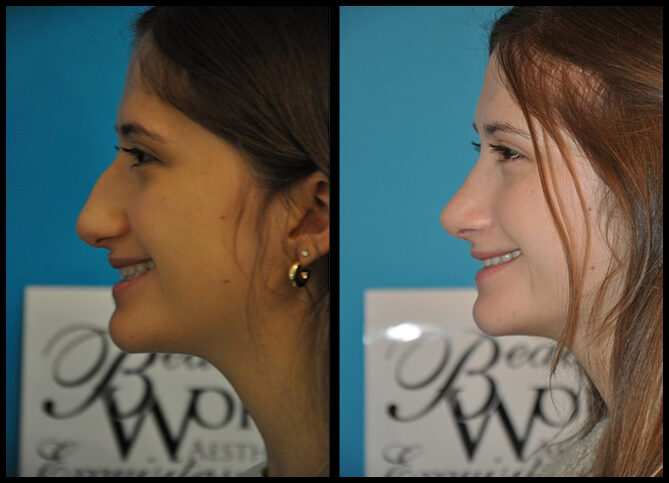 Before and After