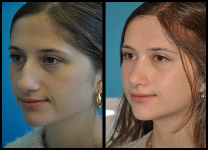 Before and After