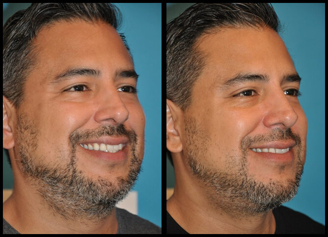 Before and After