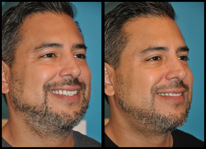 Before and After