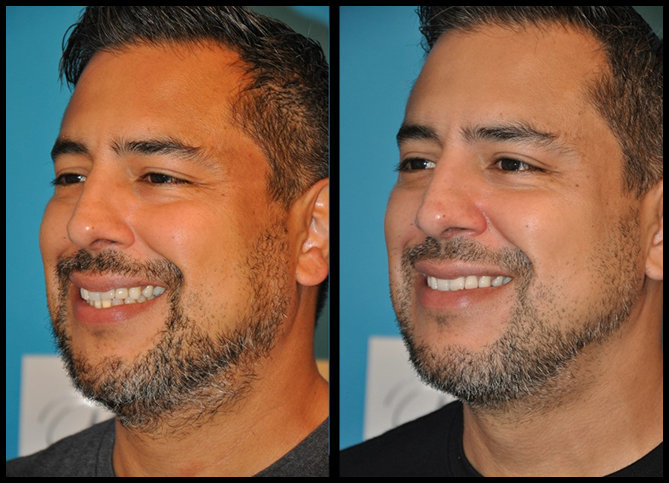 Before and After