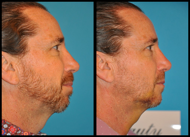 Before and After