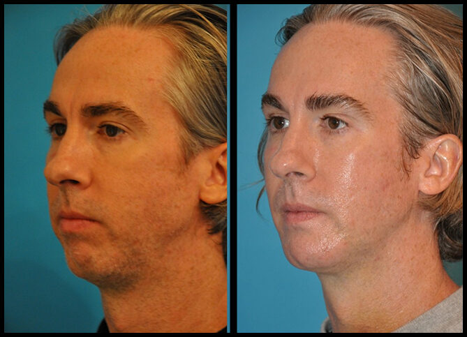 Before and After
