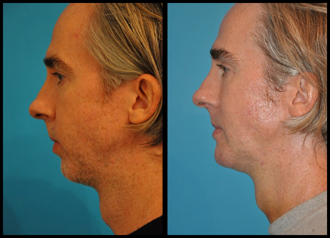 Before and After