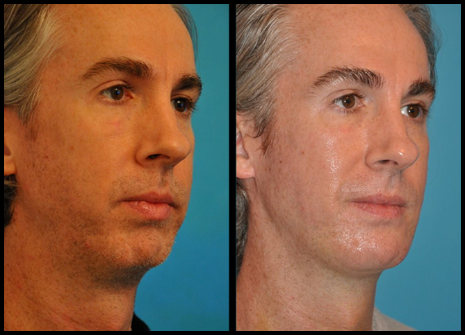 Before and After