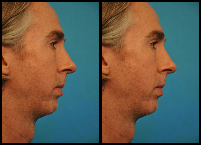 Before and After