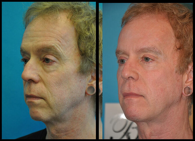 Before and After
