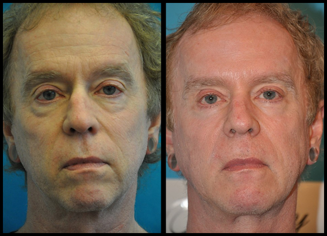 Before and After