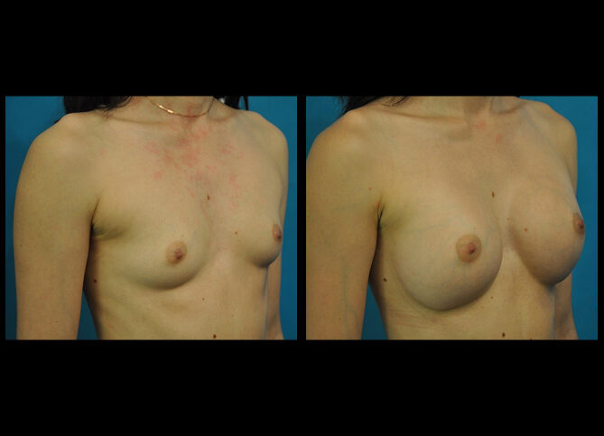 Before and After