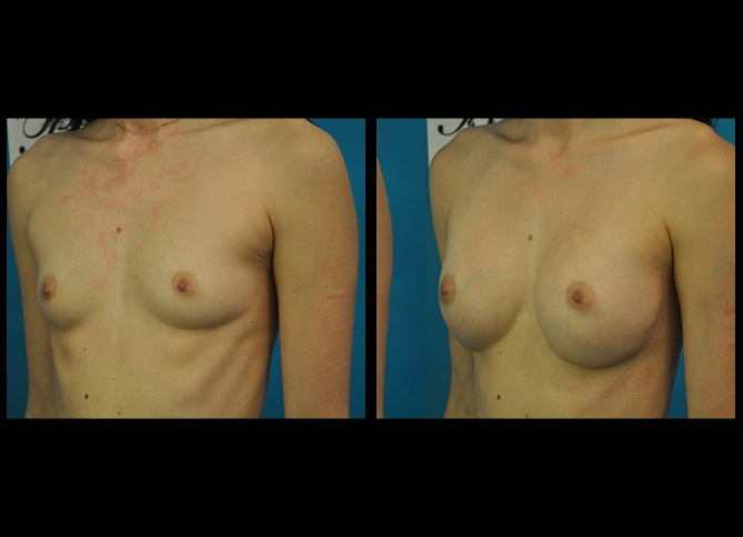 Before and After