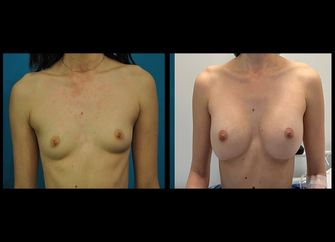 Before and After