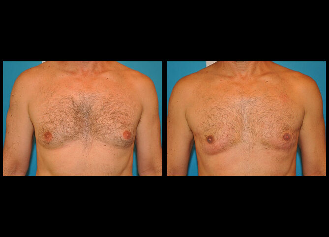 Before and After