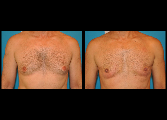 Before and After