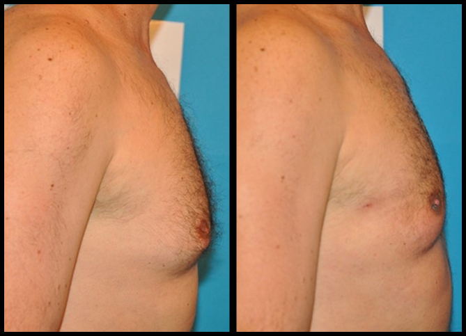 Before and After