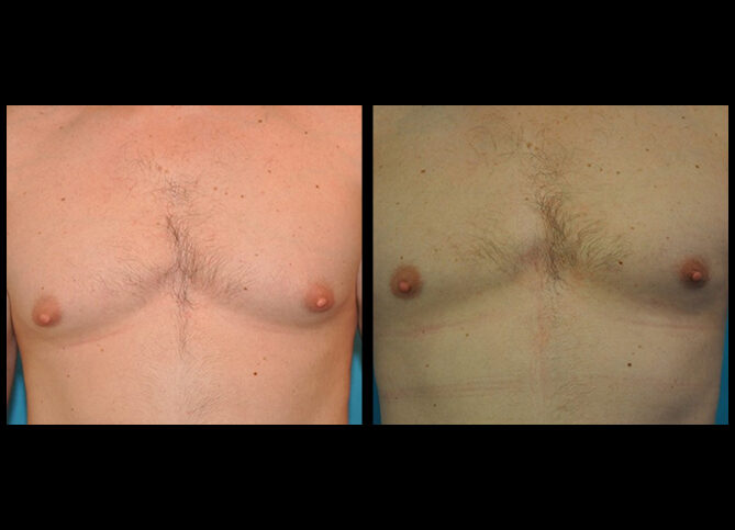 Before and After