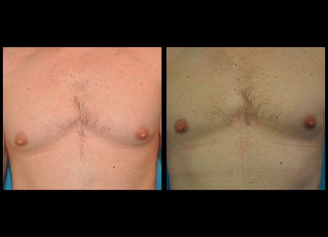 Before and After