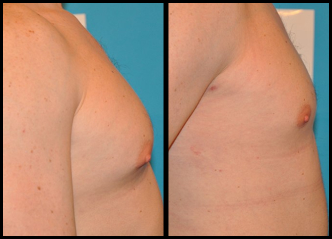 Before and After