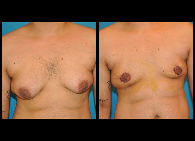 Before and After