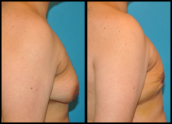 Before and After