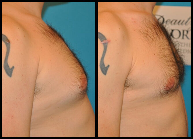Before and After