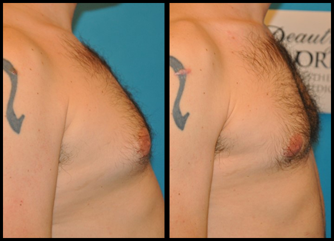 Before and After