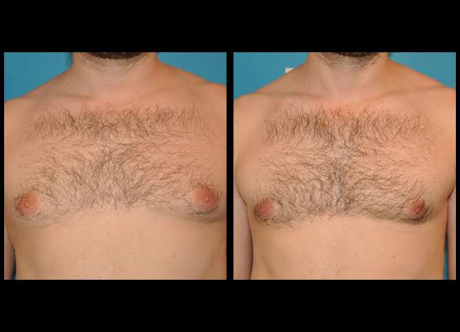 Before and After