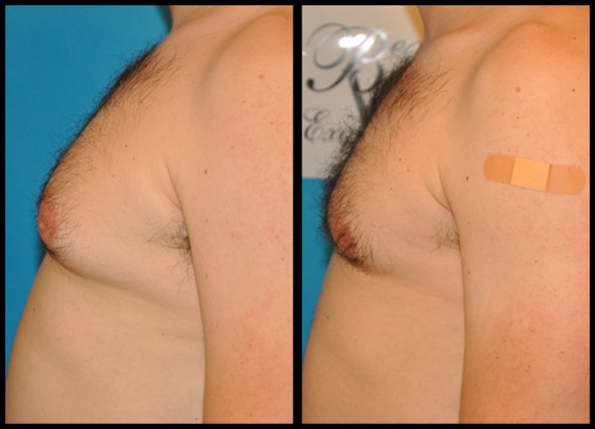 Before and After