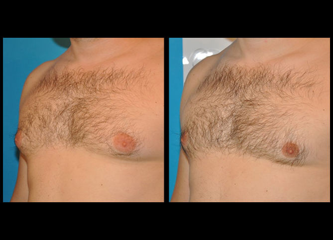Before and After