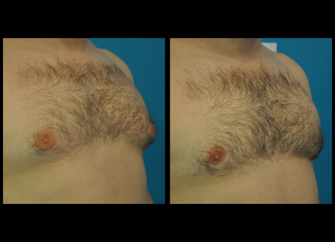 Before and After