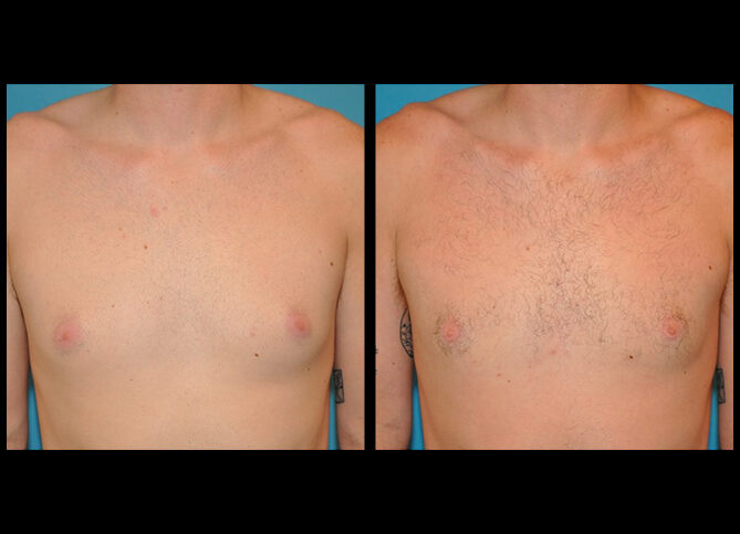 Before and After