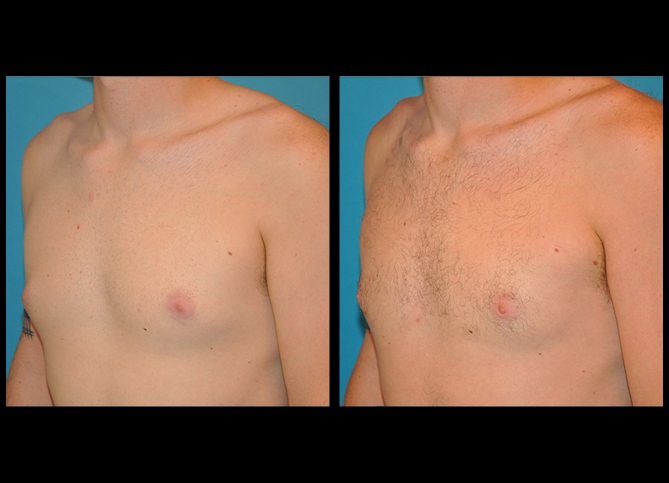 Before and After