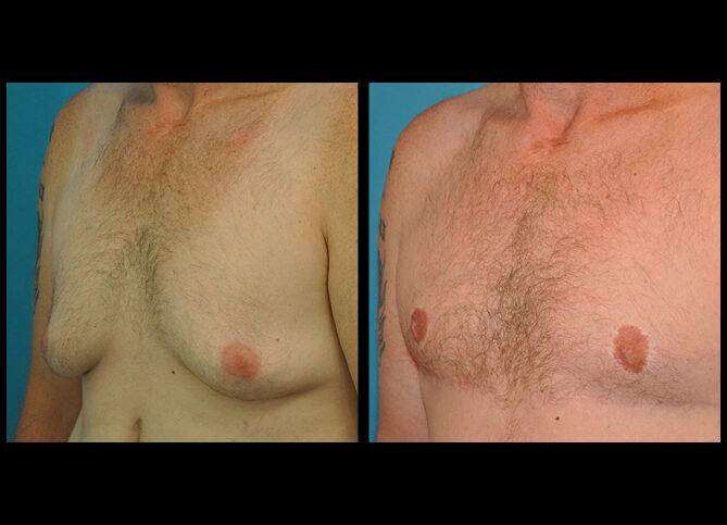 Before and After