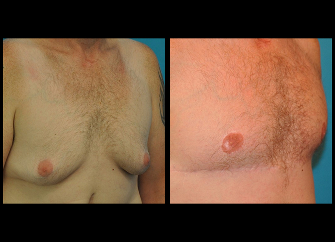 Before and After