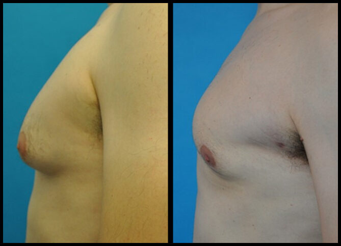 Before and After