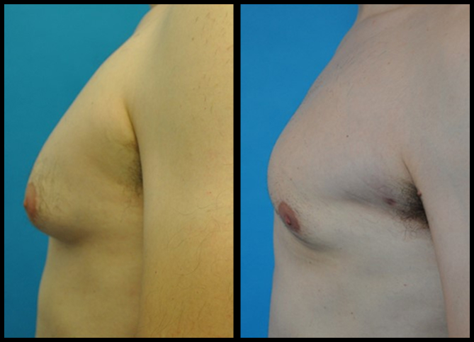 Before and After