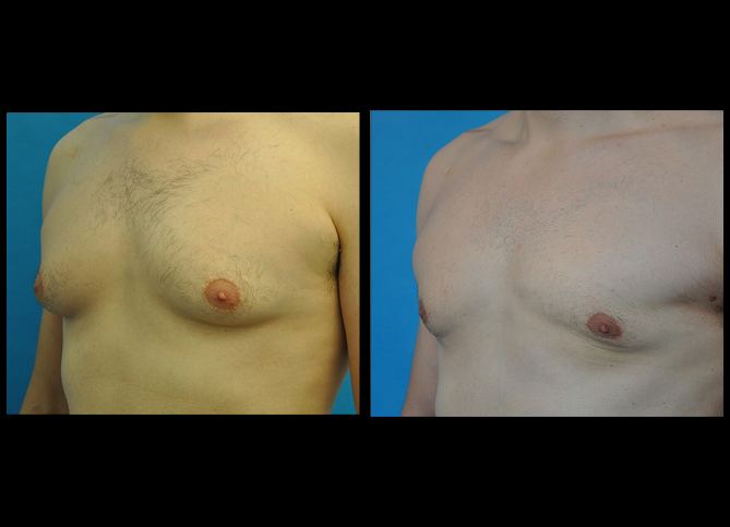 Before and After